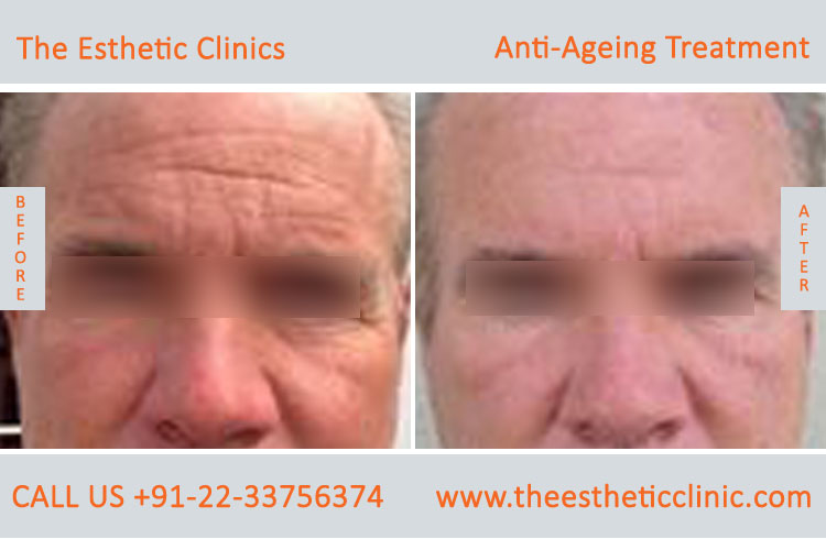 Anti Aging Treatment for Face Wrinkles before after photos in mumbai india (1 (5)
